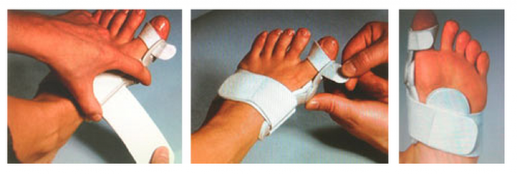 Как зафиксировать большой палец на ноге. Перелом большого пальца на ноге лангетка. Фиксатор мизинца на ноге. Как зафиксировать большой палец на ноге. Как зафиксировать большой палец на ноге.